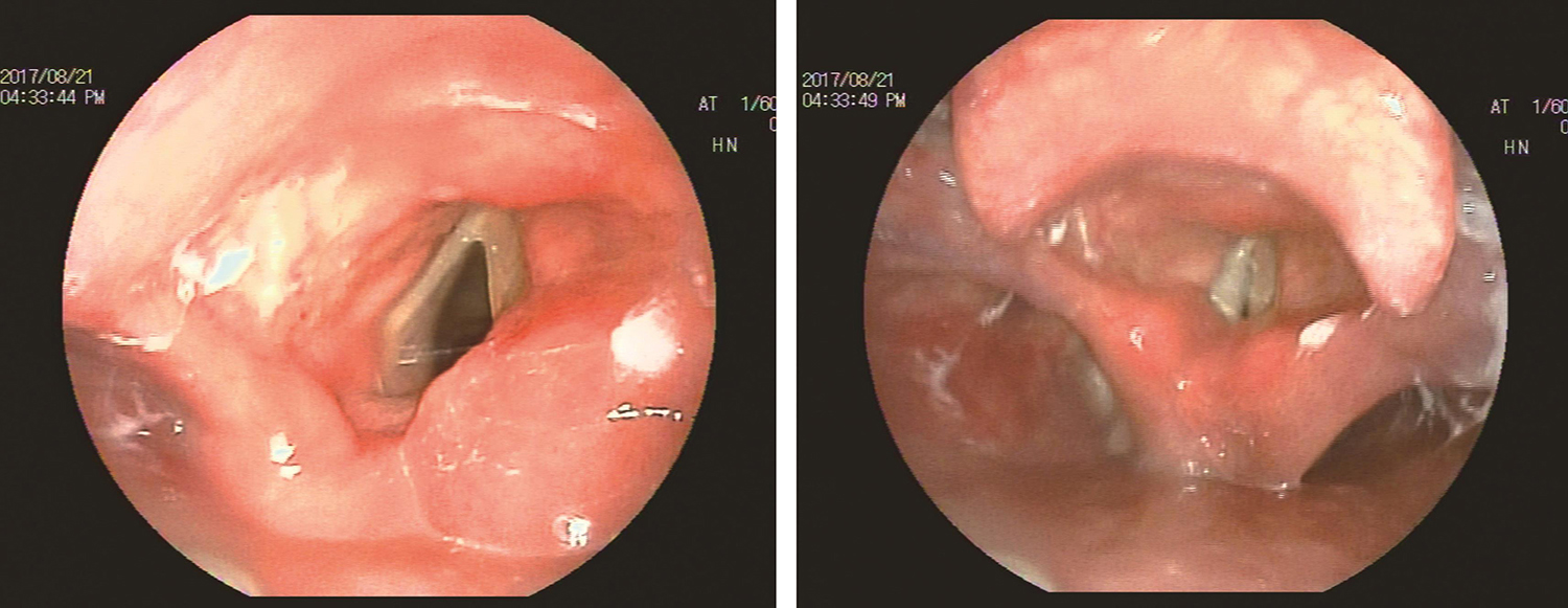 /uploads/image/2025-05-26/163845659图13 2017年8月21日复查喉镜.jpg 图13 2017年8月21日复查喉镜